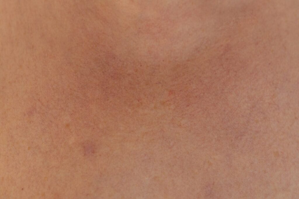 skin cancer moles