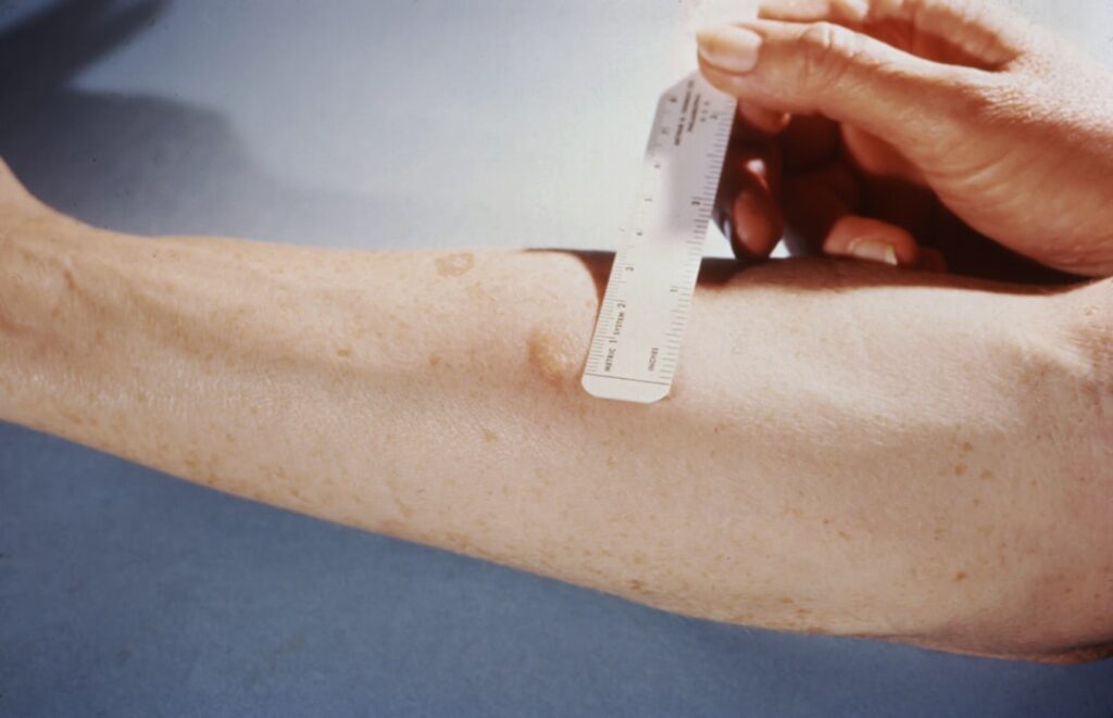early skin cancer detection